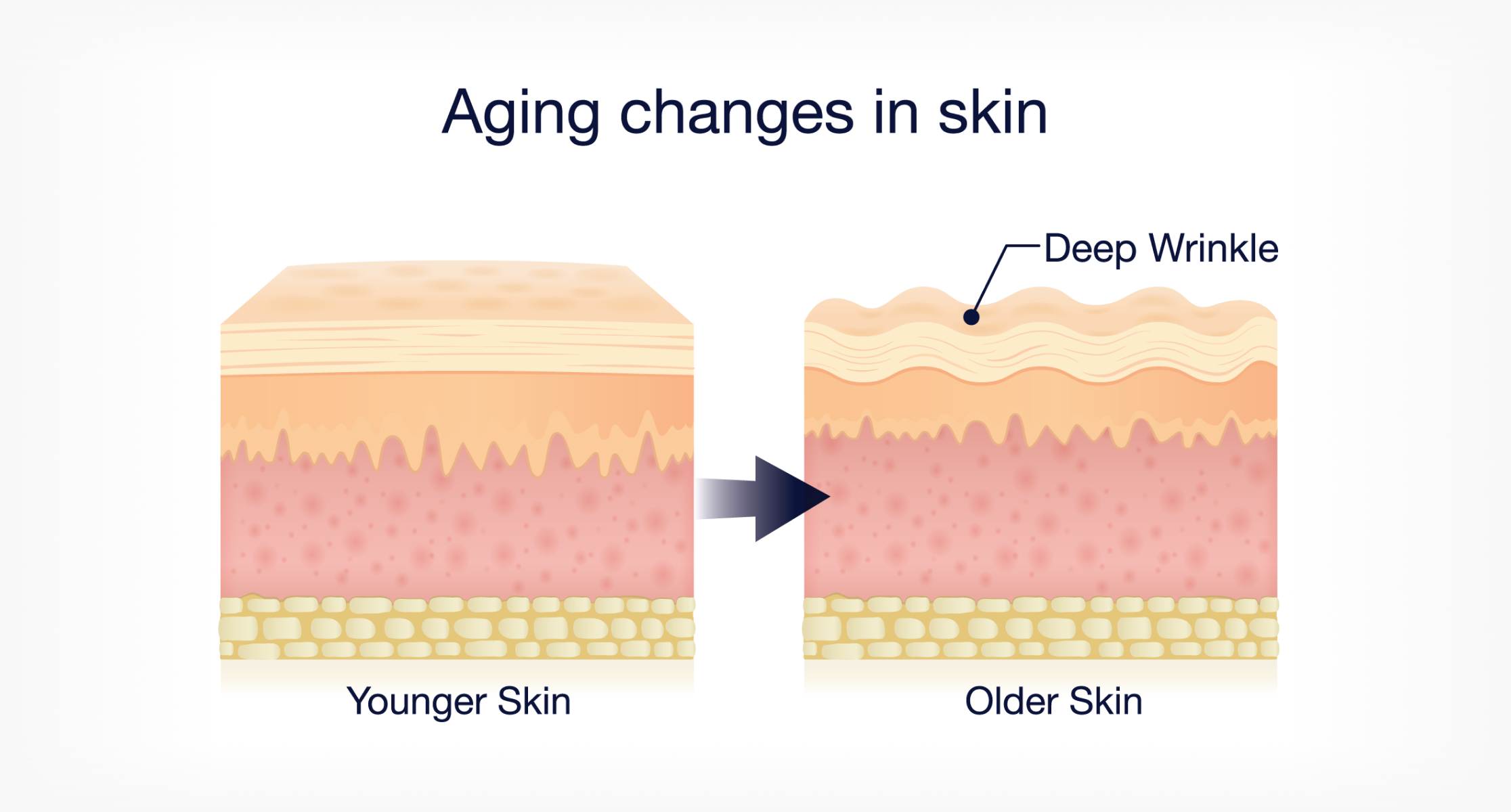 Aging changes in skin