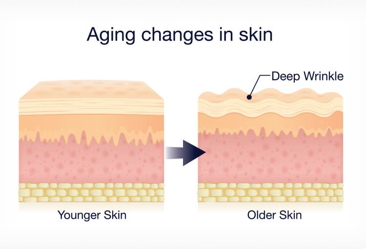 Aging changes in skin